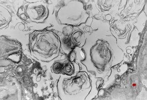 F, 2m. | surfactant deficiency